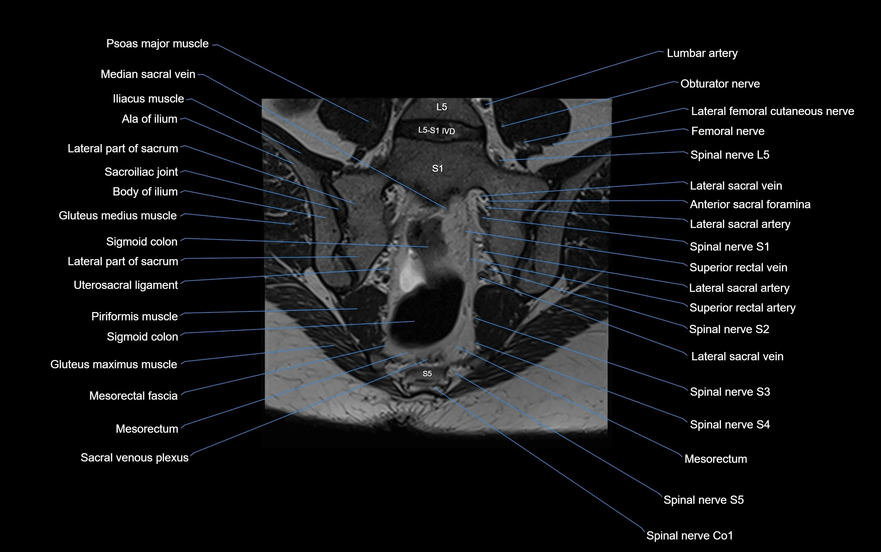 MRI sacroiliac joint coronal cross sectional anatomy  radiology  image-img-00001-00015.webp